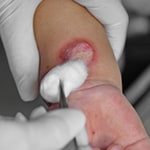 Burn Injuries Photo