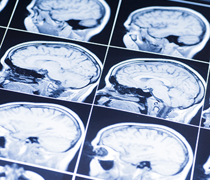Brain Injury