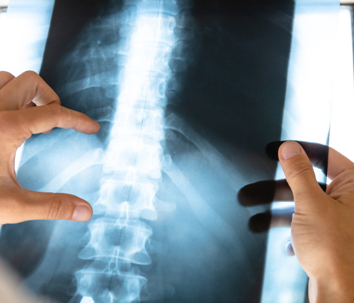 Spinal Injury